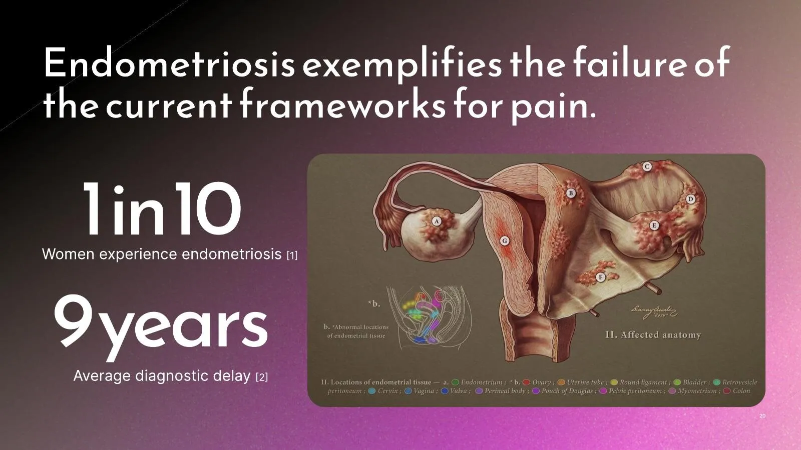Endometriosis affects 1 in 10 women, with an average 9-year diagnostic delay